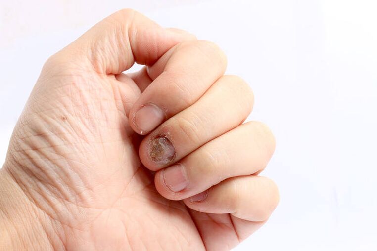 indikacija za uporabu Keramin - gljivice noktiju