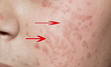 Kako prepoznati virus ljudskog papiloma