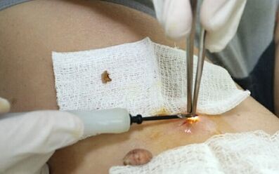 Kirurško liječenje virusa humanog papiloma