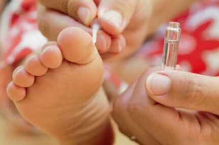 Metode za liječenje plantarnih bradavica