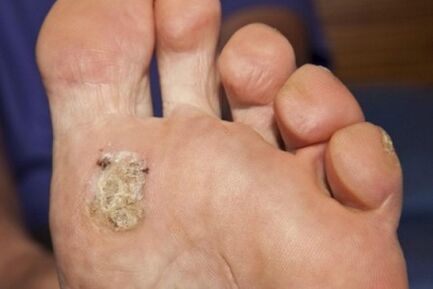 Razlozi za pojavu plantarne bradavice