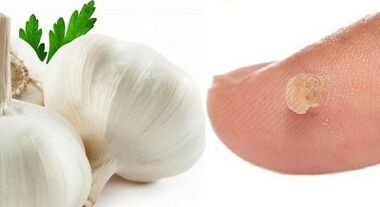 liječenje bradavica s narodnim lijekovima