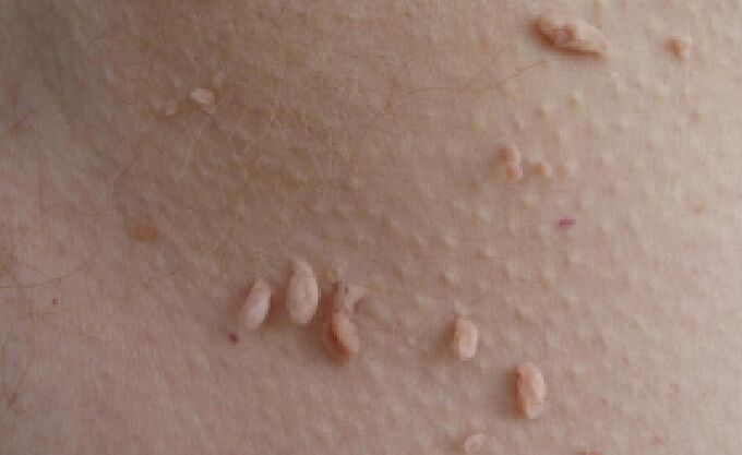 razlozi za pojavu papiloma na ljudskom tijelu