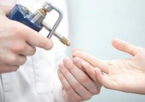 suvremene metode uklanjanja papiloma