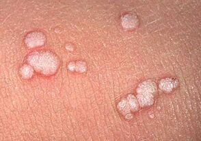 vulgarni papilomi na ljudskom tijelu