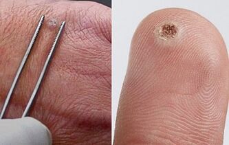 simptomi papiloma na ljudskom tijelu