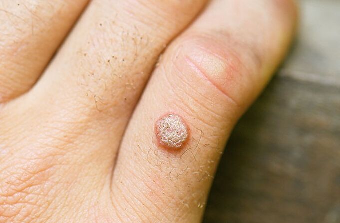 Kada se zarazi HPV-om, bradavica se može pojaviti na ruci ili drugom dijelu tijela
